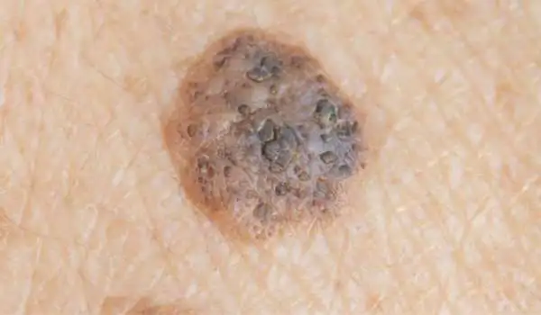 Seborrhoeic Keratosis: Benign vs Malignant Braintree