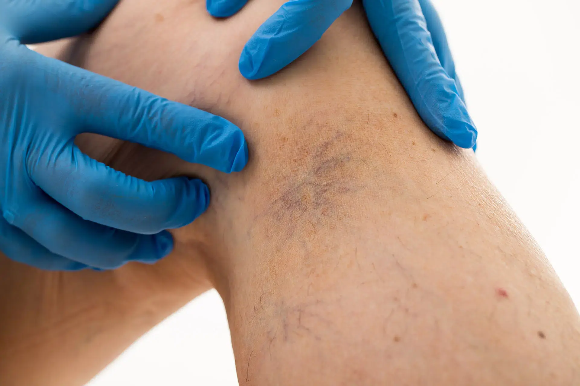 Spider Veins vs. Spider Angiomas: Understanding the Differences in CryoPen Braintree