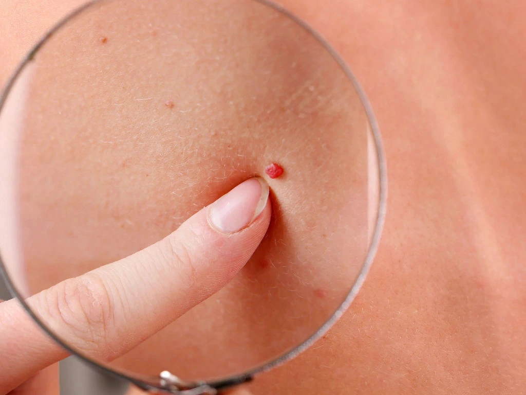 Cherry Angiomas on skin showing vascular structure and Cryosonic CryoPen treatment for effective lesion removal Braintree