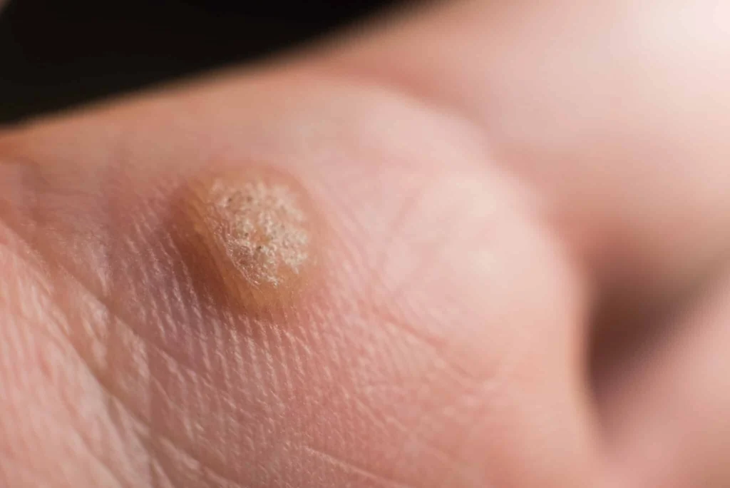 CryoPen treatment for Common Warts showing precise freezing of viral skin lesions for safe and effective removal Braintree