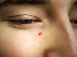 Benefits of Cryosonic CryoPen for Cherry Angiomas Braintree , showing precise, safe, and effective removal of vascular skin lesions Braintree