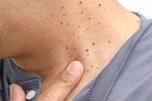 Benefits of Cryosonic CryoPen Braintree for darker skin, highlighting safe, fast, and precise removal of Dermatosis Papulosa Nigra Braintree