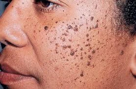 Cryosonic CryoPen treatment Braintree showing Dermatosis Papulosa Nigra on darker skin Braintree