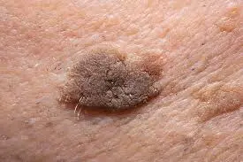 Role of CryoPen in managing Seborrhoeic Keratosis Braintree – safe and effective lesion removal Braintree