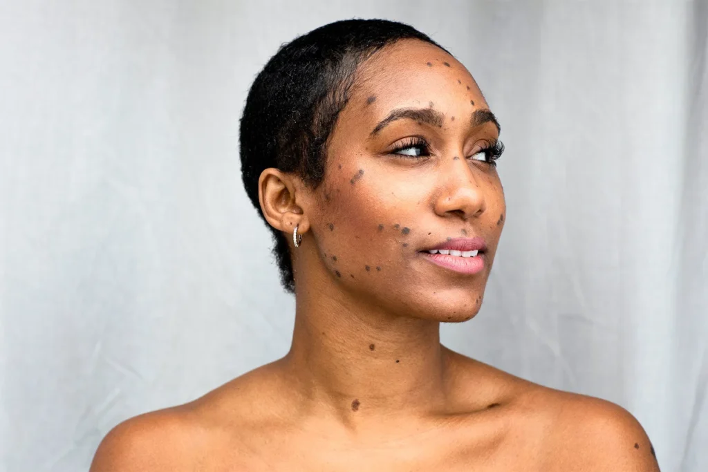 Dermatosis Papulosa Nigra on darker skin treated with Cryosonic CryoPen, showing genetic factors and effective removal Braintree