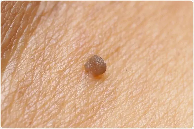 What happens in the skin to form Seborrhoeic Keratosis Braintree – causes and development of lesions Braintree