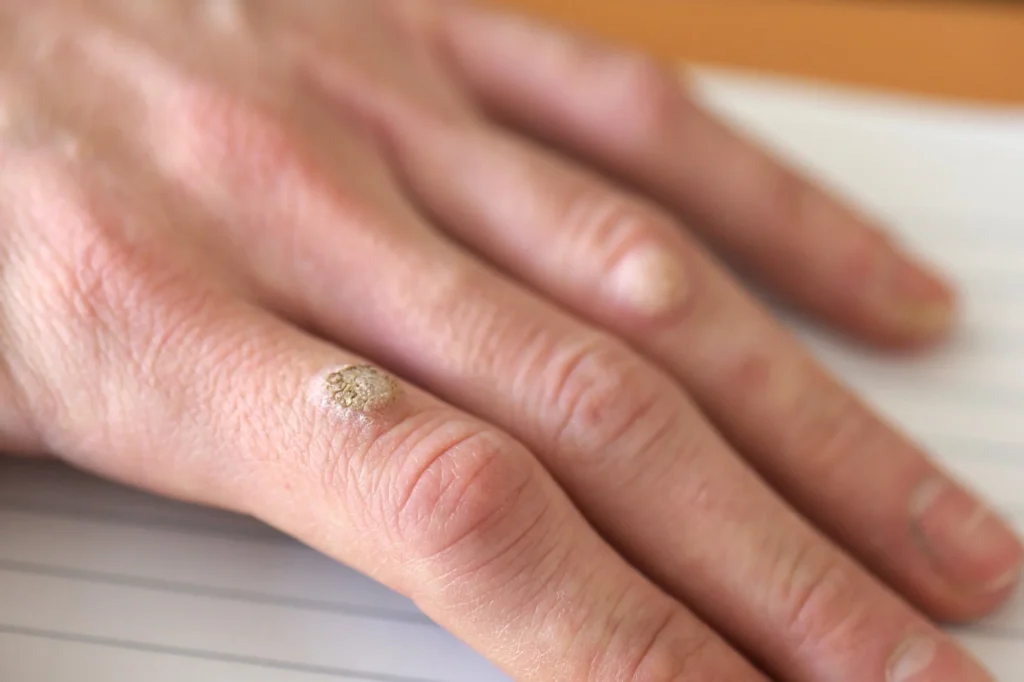 Patient considering removal of Common Warts Braintree for cosmetic improvement, comfort, and hygiene with CryoPen treatment Braintree