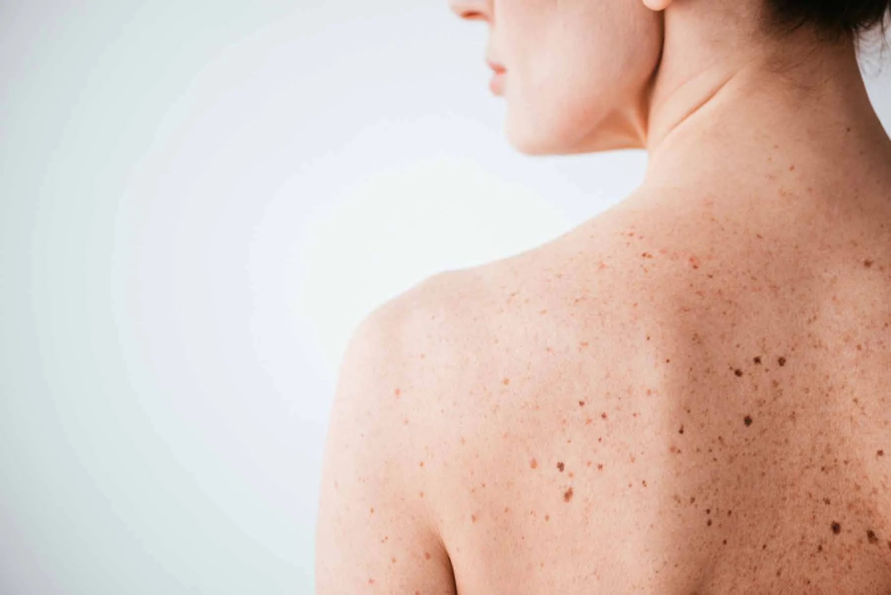 Sun Damage : Understanding UV Effects and Skin Repair Options Braintree