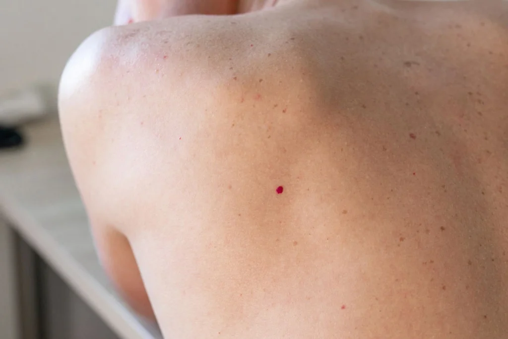Close-up of Cherry Angiomas Braintree on skin, showing small red vascular lesions and their typical appearance Braintree