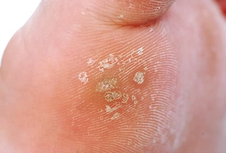 Close-up of Common Warts Braintree on skin, showing small rough viral lesions typically caused by HPV infection Braintree
