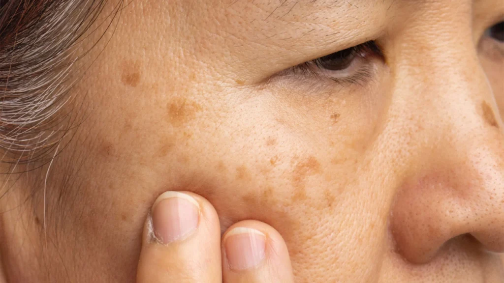 What exactly is Seborrhoeic Keratosis Braintree – causes, symptoms, and appearance Braintree