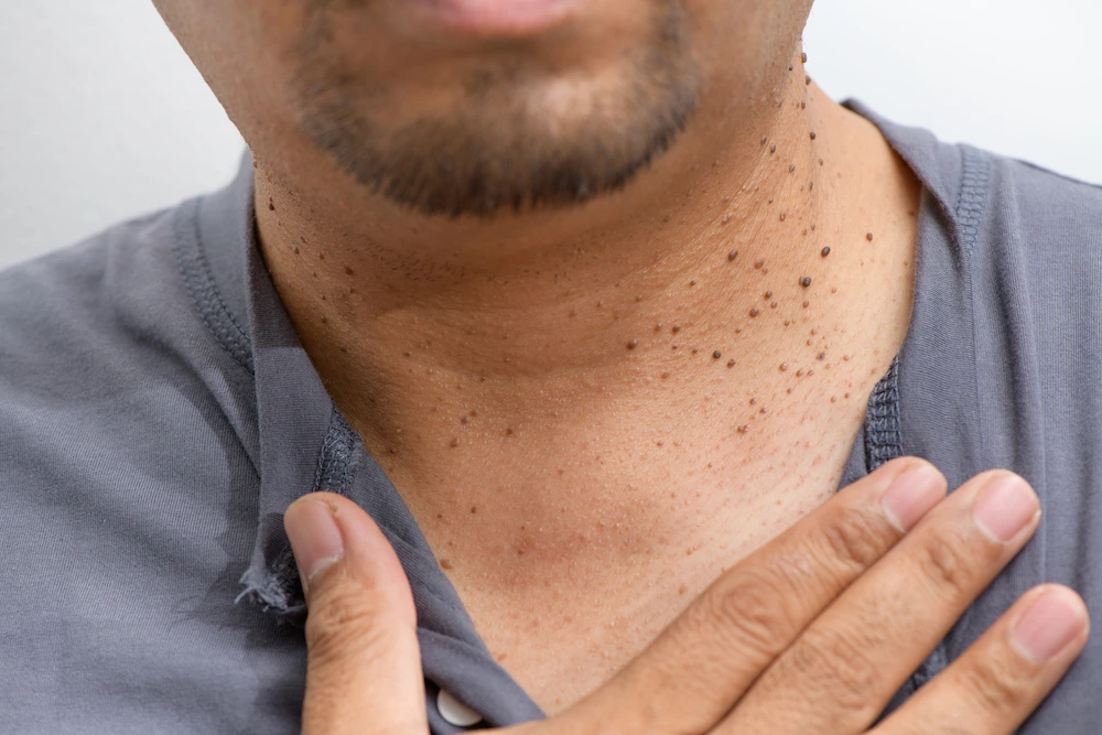 Dermatosis Papulosa Nigra Braintree on darker skin, showing genetic factors Braintree