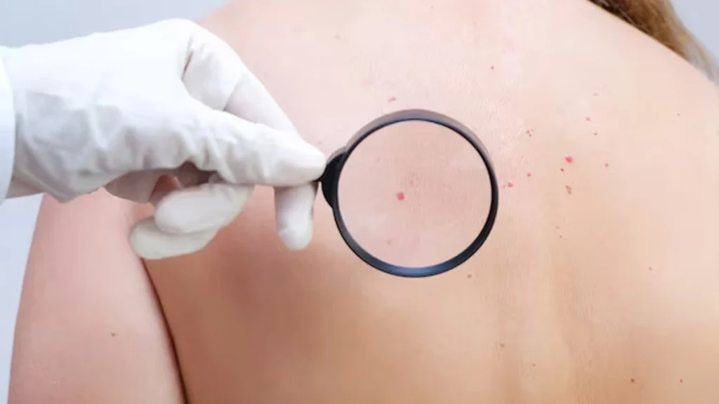 Person considering Cherry Angiomas Braintree removal, highlighting cosmetic and comfort reasons for treatment with CryoPen Braintree